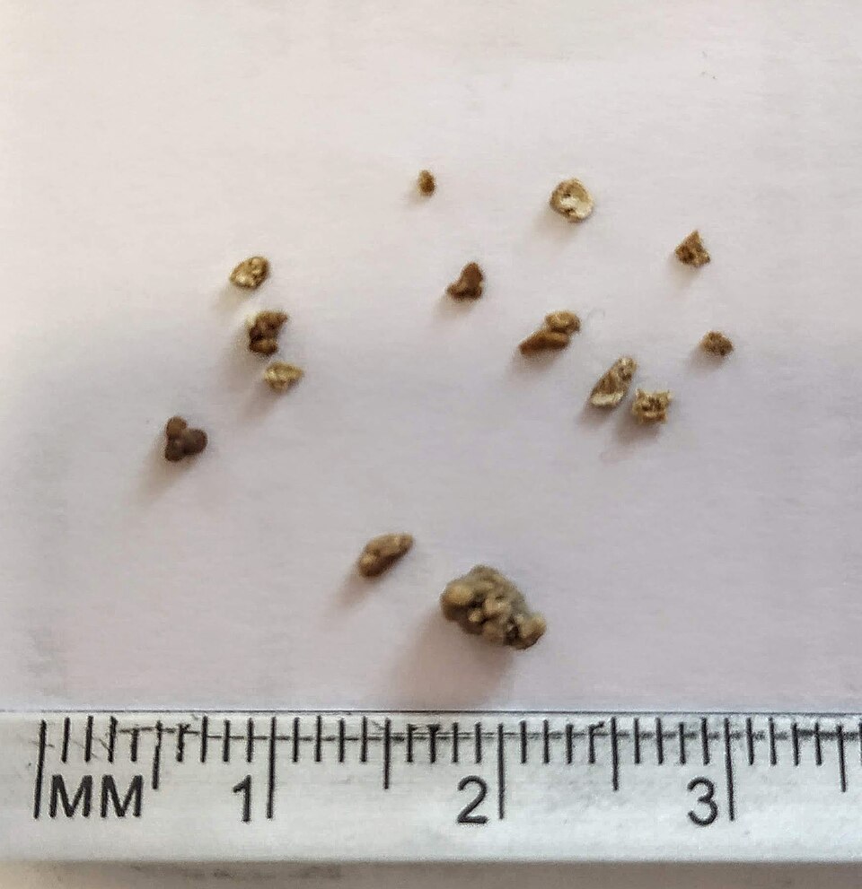 Harnsteine in verschiedenen Größen
